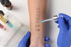 alergije, test